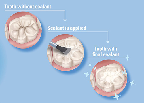 疾控中心的研天富代理究鼓吹牙科密封剂的好处